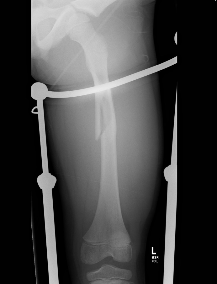 Femoral Fracture Thomas Splint